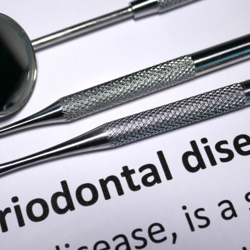Per Quanto Tempo Puoi Ignorare la Malattia Parodontale?